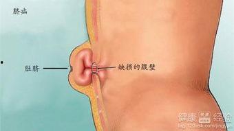 成人脐疝形成过程视频,从胚胎发育到病状显现-第2张图片-成人影视大全