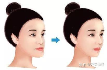 成人反颌矫正流程视频,从诊断到康复-第1张图片-成年电影网