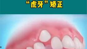 成人反颌矫正流程视频,从诊断到康复-第2张图片-成年电影网
