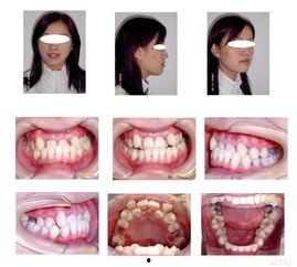 成人反颌矫正流程视频,从诊断到康复-第3张图片-成年电影网