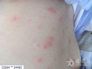 成人水痘的恢复过程视频,症状演变与康复过程-第2张图片-成年电影网