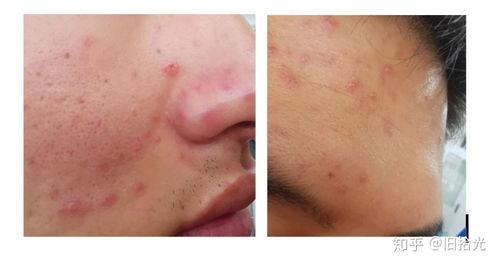 成人水痘的恢复过程视频,症状演变与康复过程-第3张图片-成年电影网