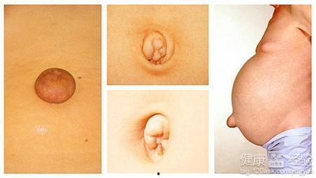 成人脐疝门诊手术视频播放,直观教学视频深度解读-第1张图片-成年电影网